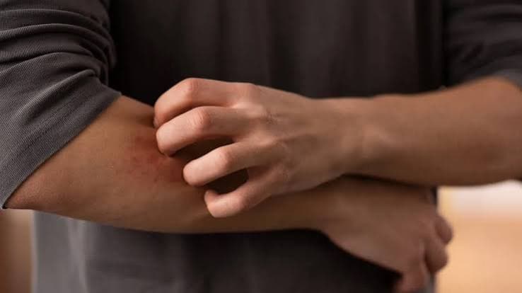Aumento dei casi di dermatofilosi in Europa: Pregliasco rassicura sul basso rischio ma segnala nuove modalità di contagio